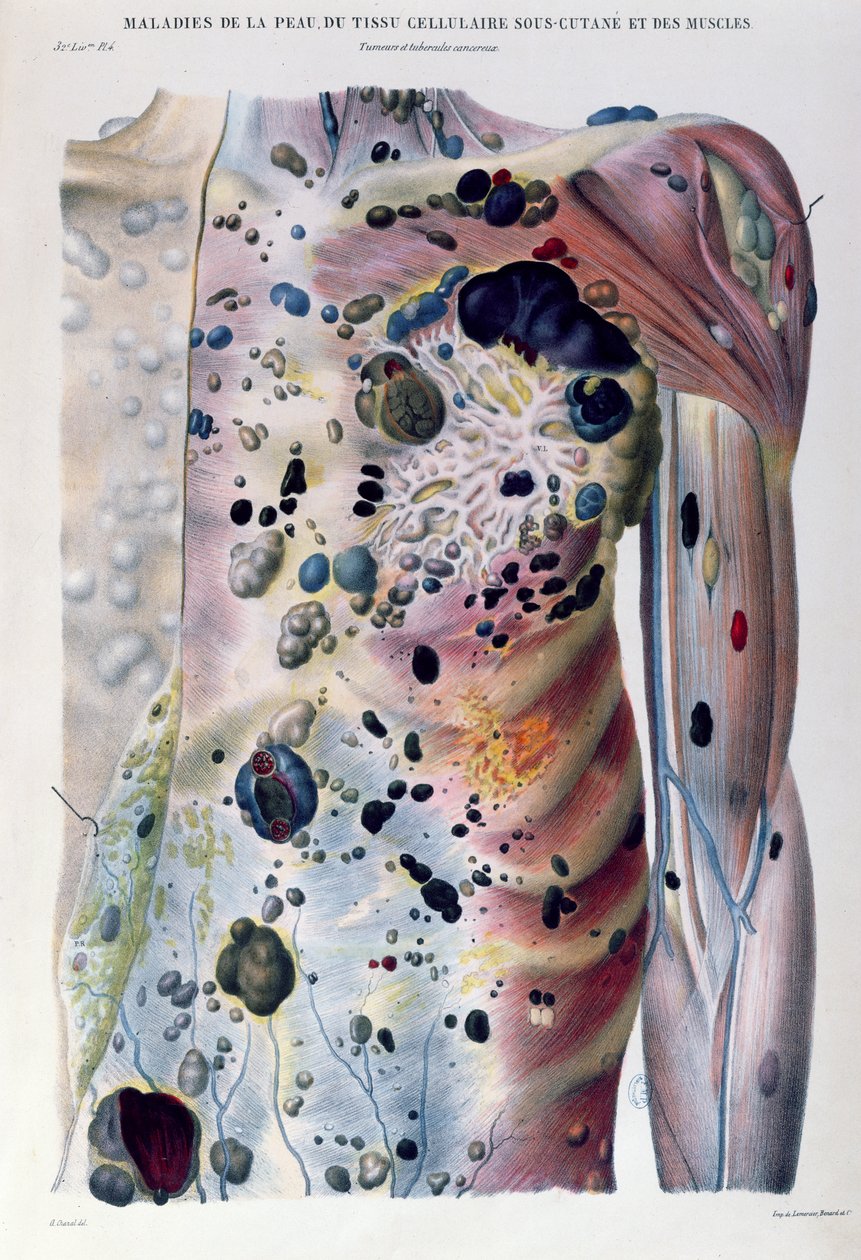 Tumori e tubercoli cancerosi, da 