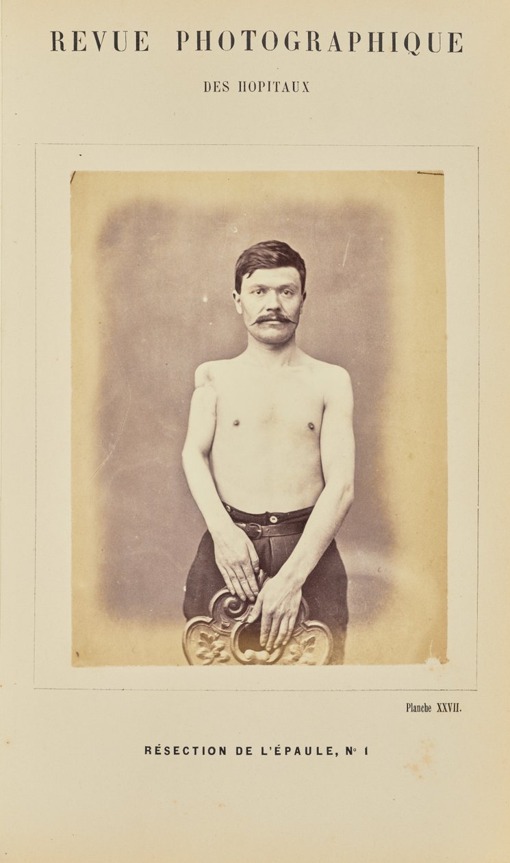 Resezione della spalla, numero 1 da Arthur de Montmeja