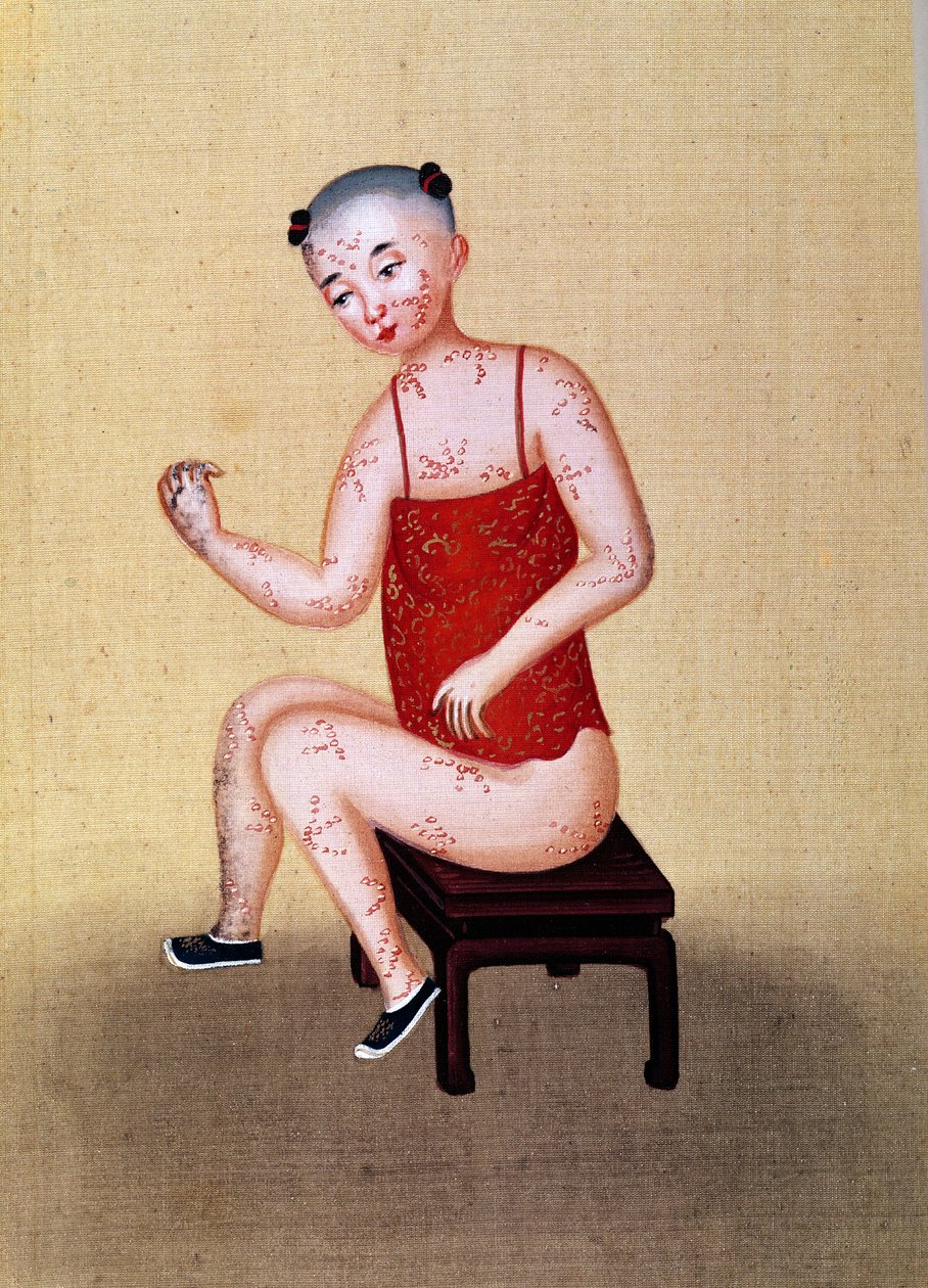 Bambino con vaiolo da Chinese School