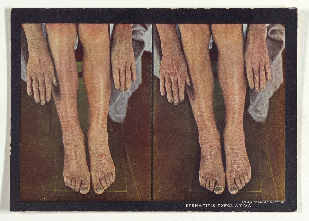 Dermatite esfoliativa da Dr. Selden I. Rainforth