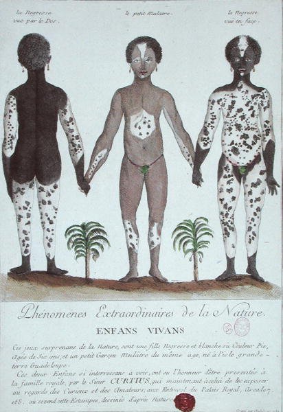 Il fenomeno della leucoderma da French School