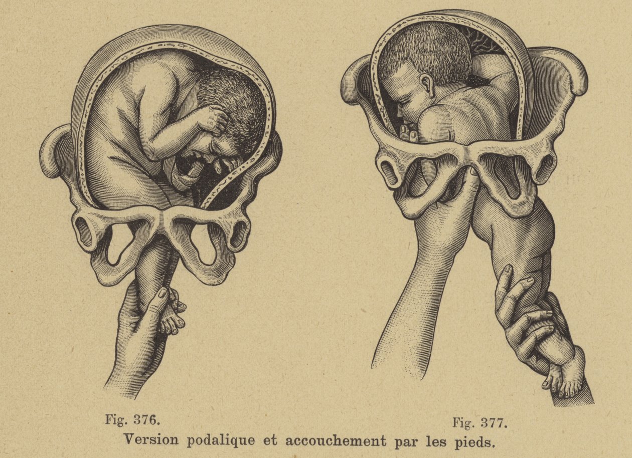 Parto podalico (nascita podalica) da German School