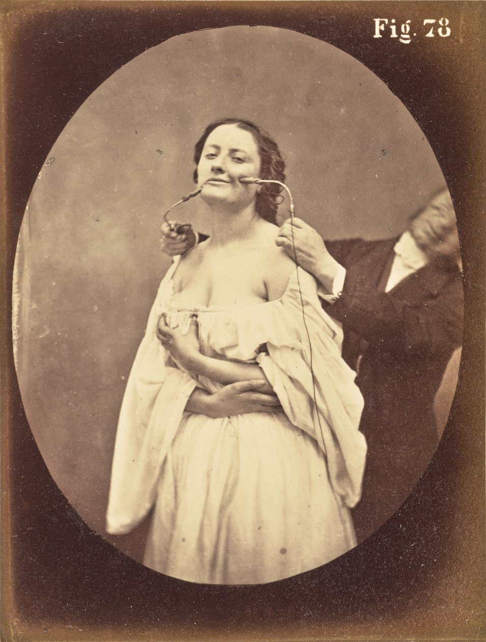 Fig. 78 da Guillaume Benjamin Duchenne