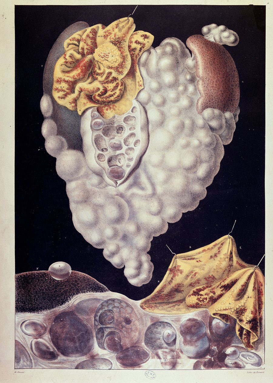 Cancro - da Cruveilhier da Jean Cruveilhier
