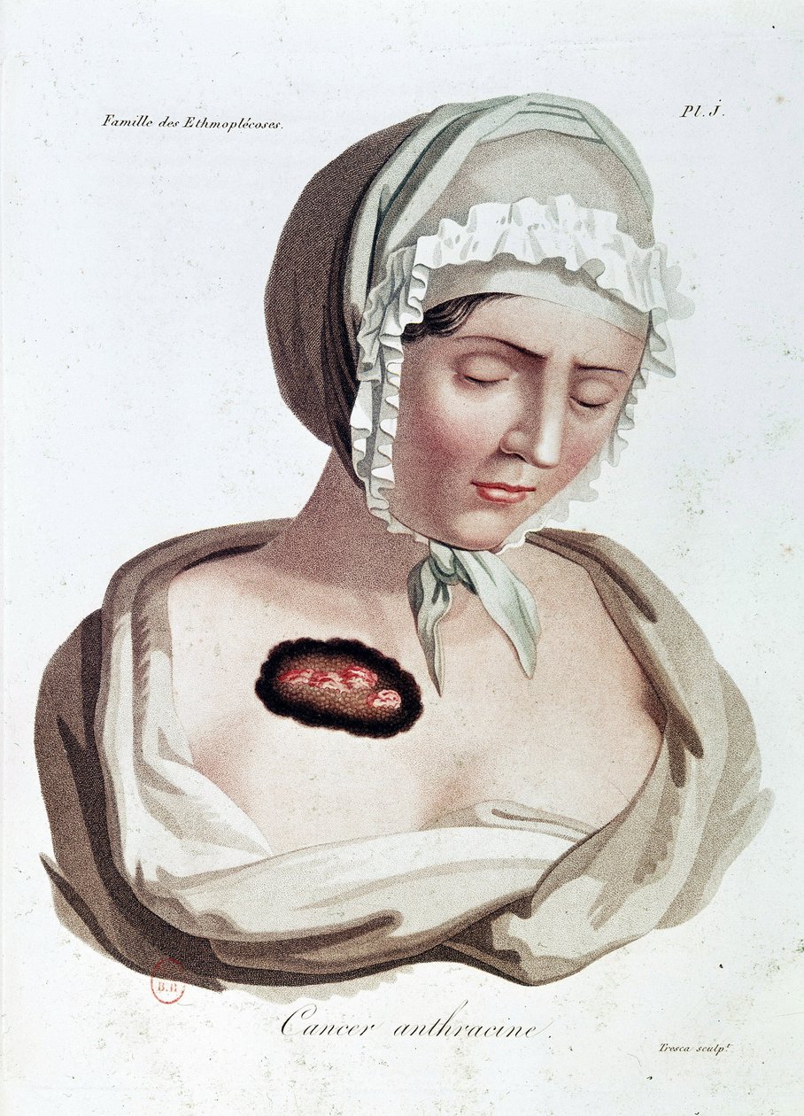 Cancro antracico - Alibert, B.N. da Jean Louis Alibert