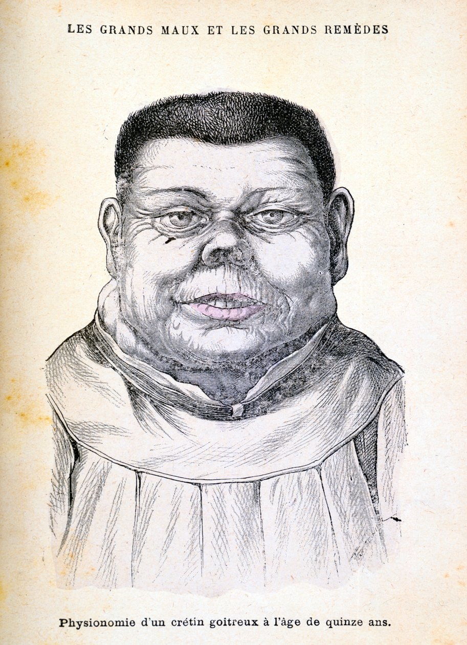 Cretino di 15 anni, c1890 da Unbekannt