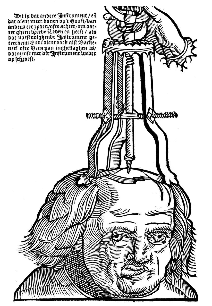 Trapanazione, 1593 da Unbekannt