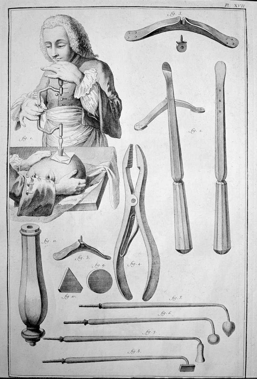 Trepanazione del cranio, vari strumenti da Unknown artist